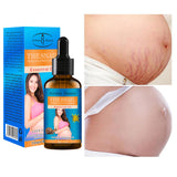 Aichun Beauty Natural Snail Extract Skin Care Repair Treatment Stretch Marks Oil 30ml -AC226-4